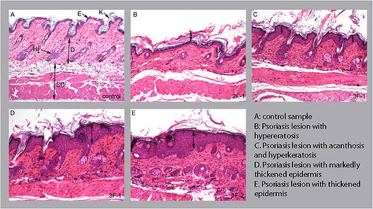 histology of the skin in the IMQ-induced psoriasis-like model of skin inflammation, preclinical CRO